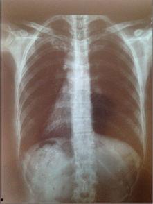 胸片爆料2023年最新,影像技术革新下的健康守护 第3张 胸片爆料2023年最新,影像技术革新下的健康守护 第3张